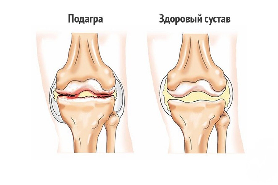 Подагра: признаки и лечение